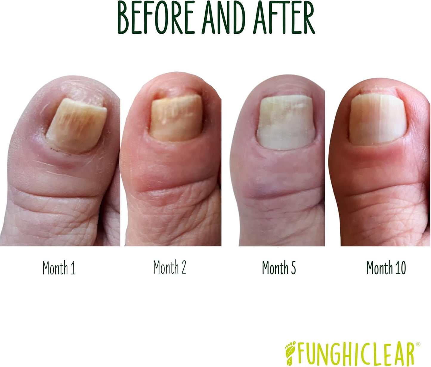 FunghiClear™ Anti-Fungal Spray