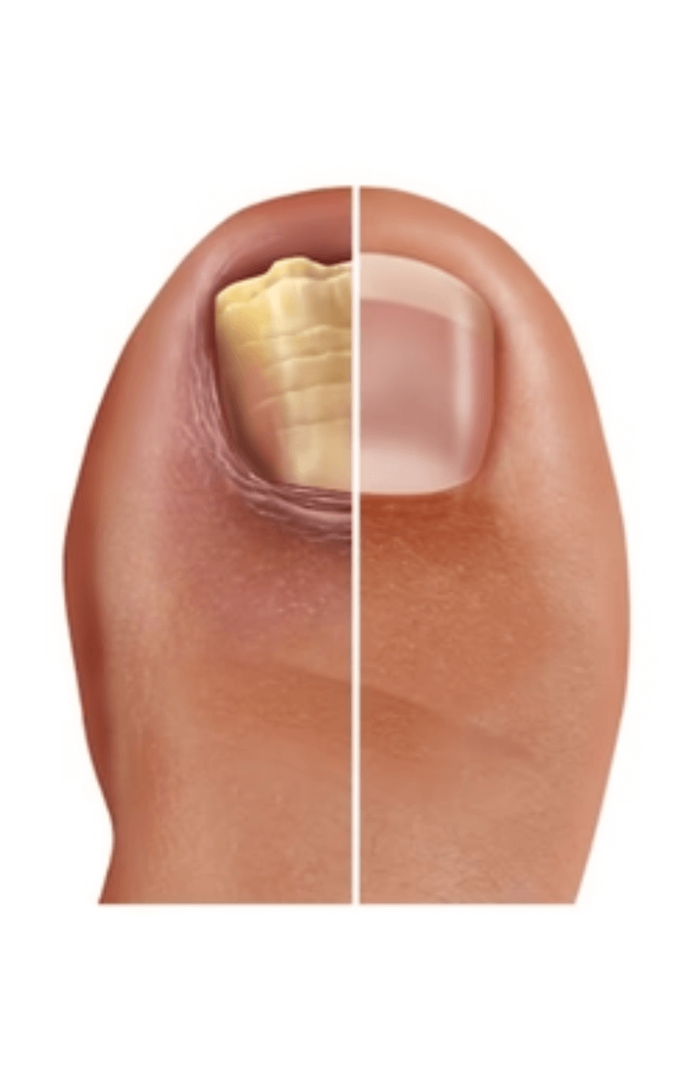 Close up of an animated toenail before and after nail fungus treatment