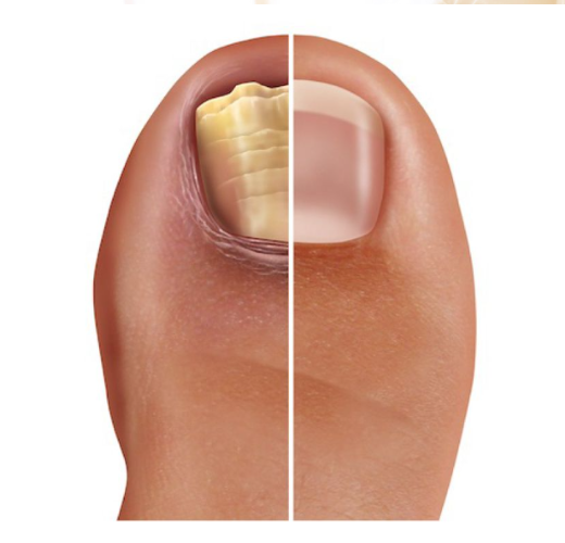 Discoloration, Distortion & Damage: The Progression of Toenail Fungal Infections