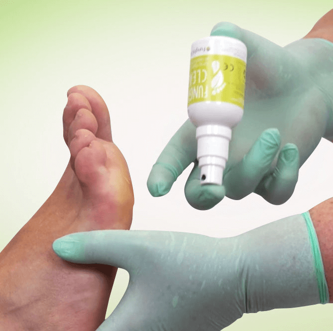 Image showing practioner spraying foot with FunghiClear