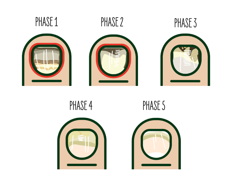 Illustration showing all 5 treatment stages